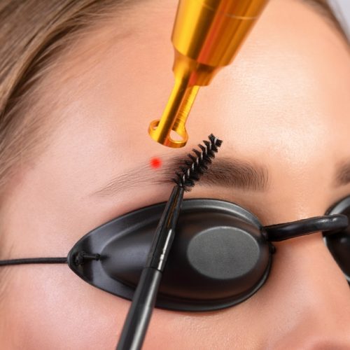 Removal,Of,Permanent,Makeup,On,The,Eyebrows.carbon,Face,Peeling,In